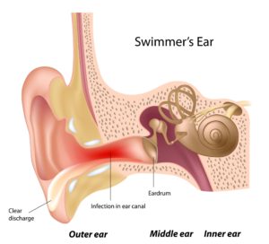 Outer ear infection affects the external ear canal. Also know as "swimmer's ear"