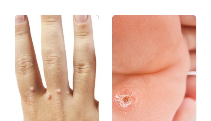 What is it With Warts? - Dr Mark McGrath