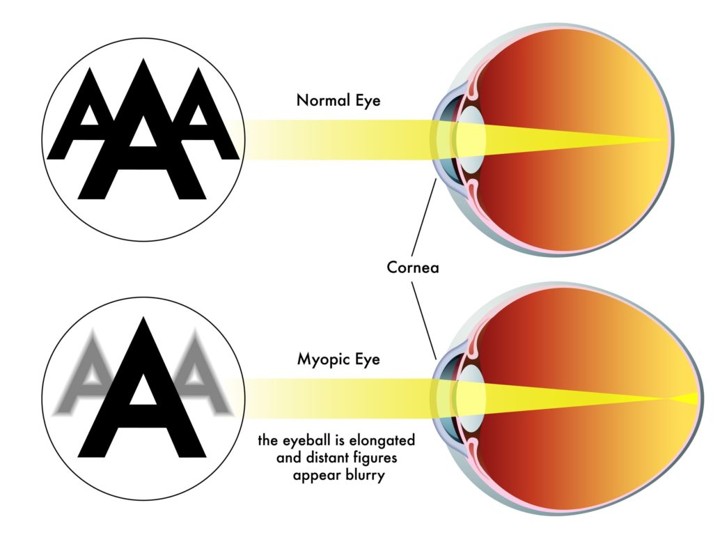 Amblyopia Why Checking Your Child’s Vision is So Important Dr Mark