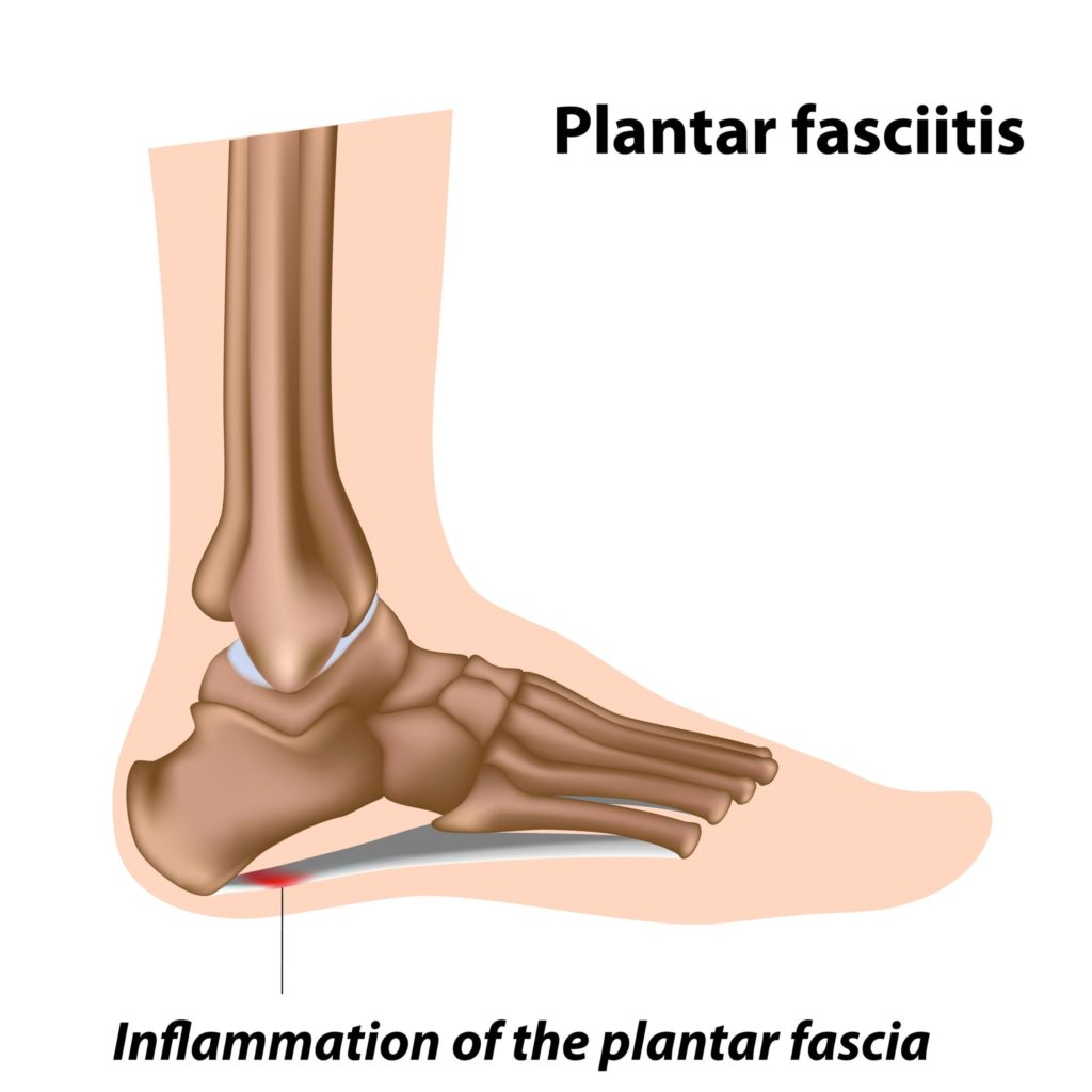 Plantar fasciitis occurs at the insertion of the plantar fascia Dr