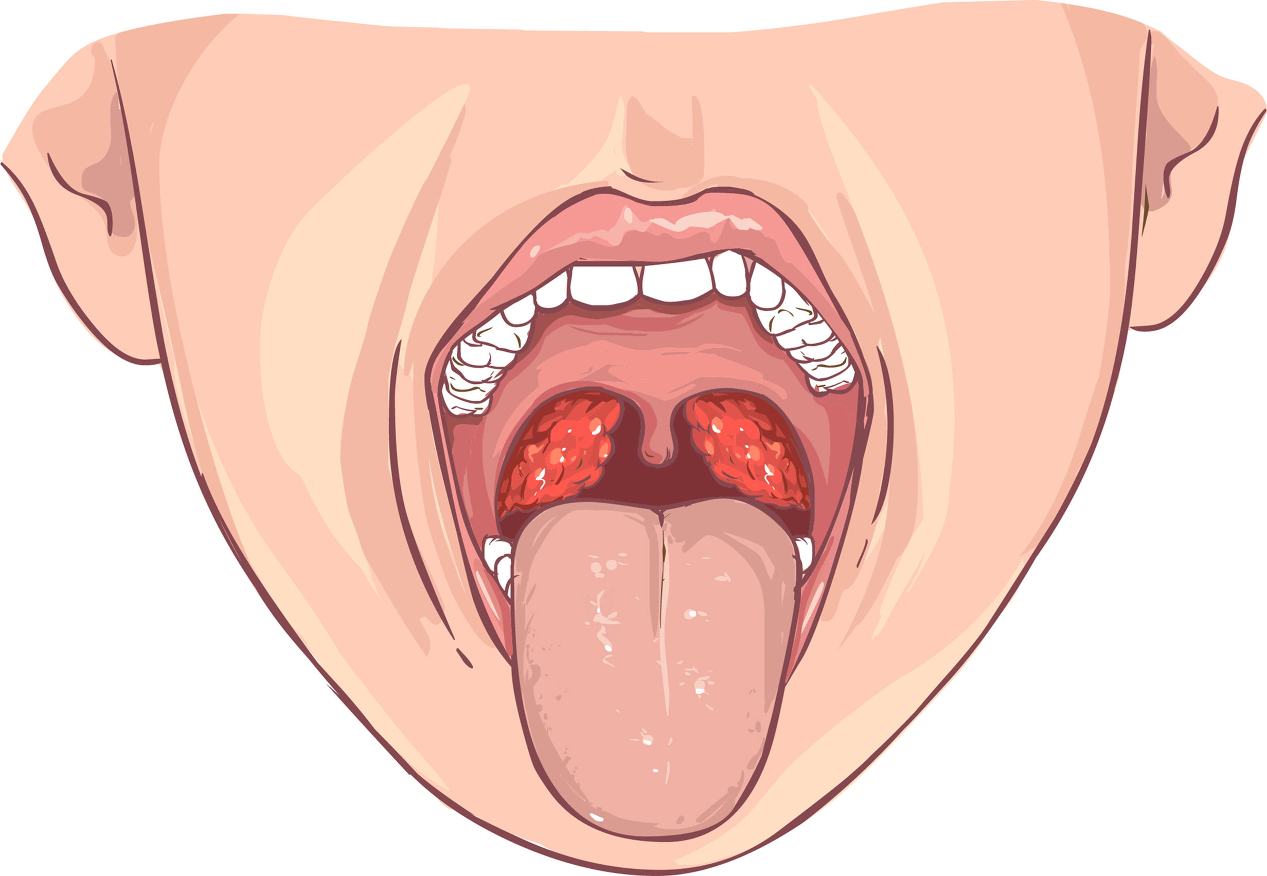 powerful-home-remedies-for-tonsillitis